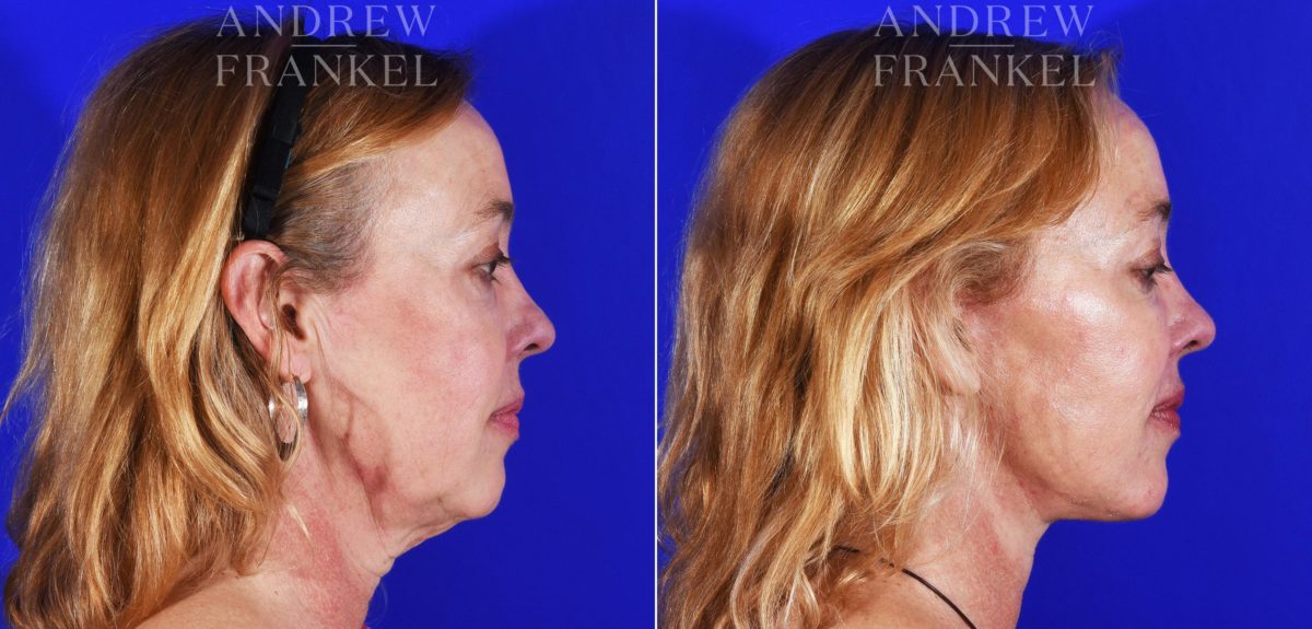 Facelift before and after photos in Beverly Hills, CA, Patient 8492