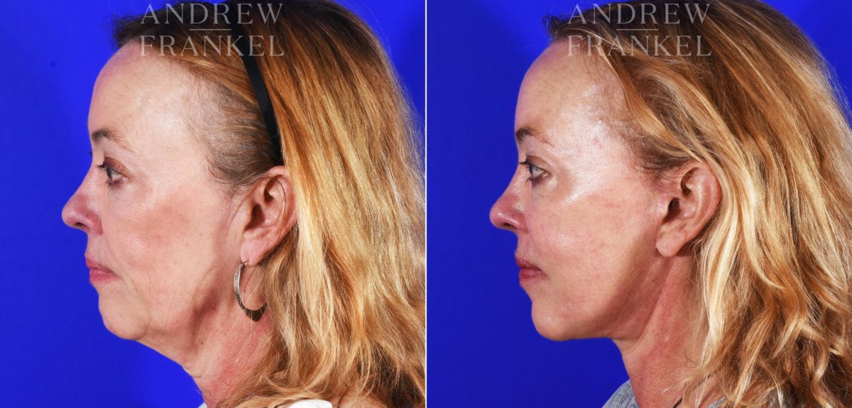 Facelift before and after photos in Beverly Hills, CA, Patient 8492