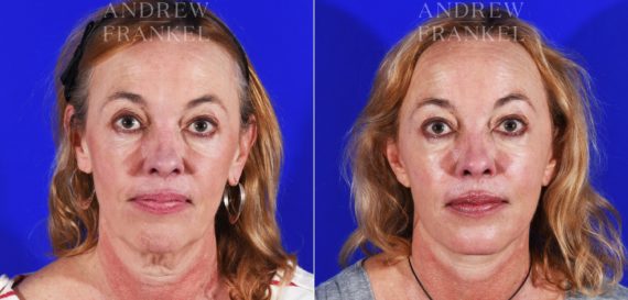 Facelift before and after photos in Beverly Hills, CA, Patient 8492