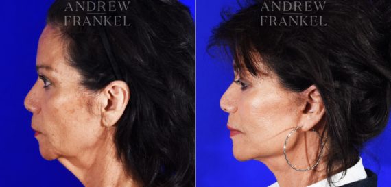 Facelift before and after photos in Beverly Hills, CA, Patient 8591