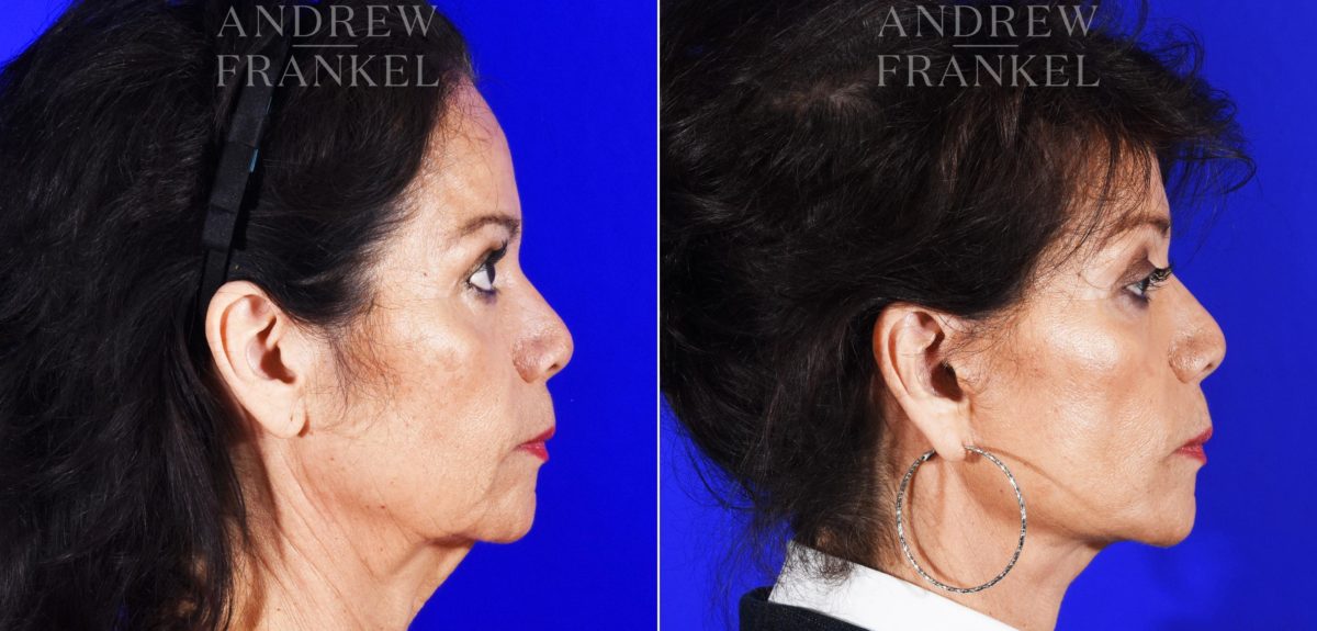 Facelift before and after photos in Beverly Hills, CA, Patient 8591