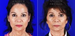 Facelift before and after photos in Beverly Hills, CA, Patient 8591