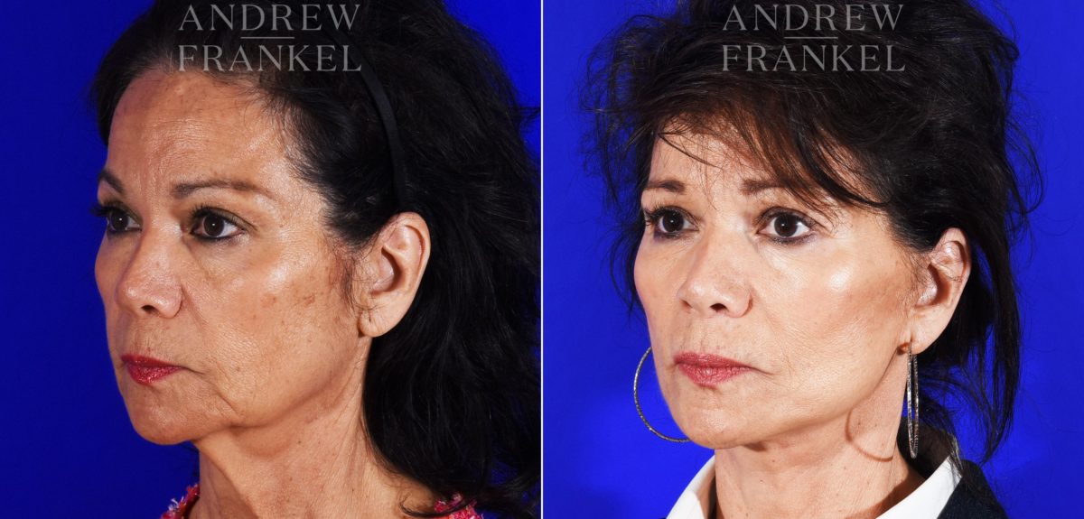 Facelift before and after photos in Beverly Hills, CA, Patient 8591