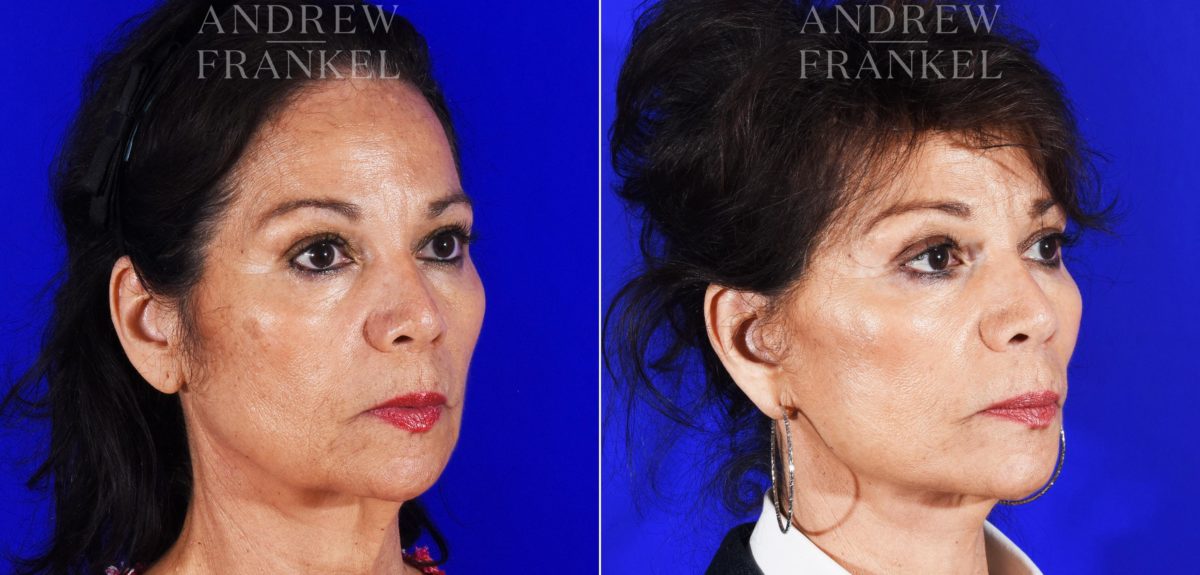 Facelift before and after photos in Beverly Hills, CA, Patient 8591