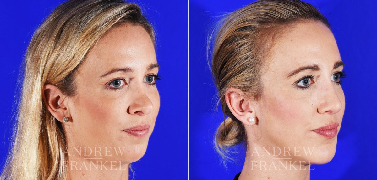 Revision Rhinoplasty before and after photos in Beverly Hills, CA, Patient 8642