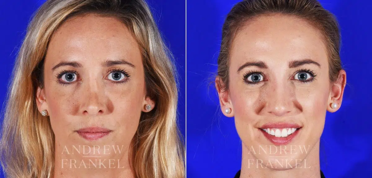 Revision Rhinoplasty before and after photos in Beverly Hills, CA, Patient 8642