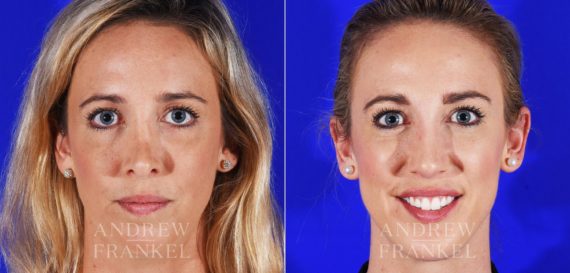 Revision Rhinoplasty before and after photos in Beverly Hills, CA, Patient 8642