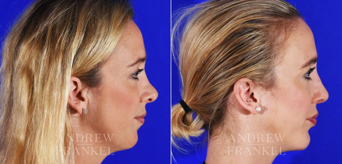 Revision Rhinoplasty before and after photos in Beverly Hills, CA, Patient 8642