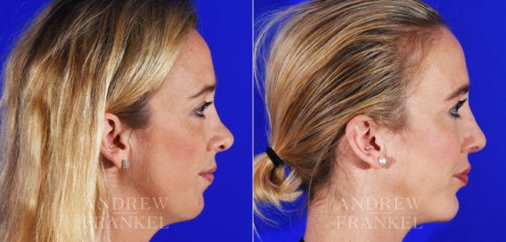 Revision Rhinoplasty before and after photos in Beverly Hills, CA, Patient 8642