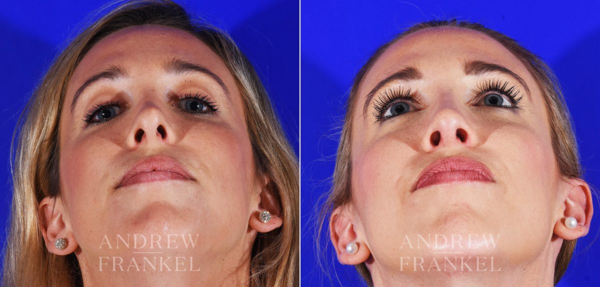 Revision Rhinoplasty before and after photos in Beverly Hills, CA, Patient 8642