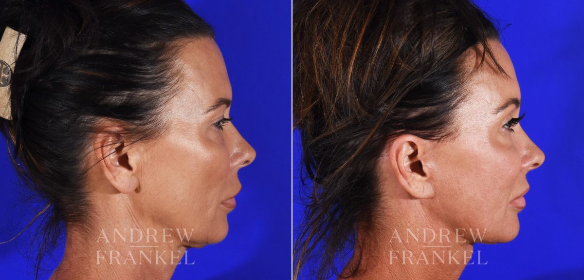 Brow Lift before and after photos in Beverly Hills, CA, Patient 8747