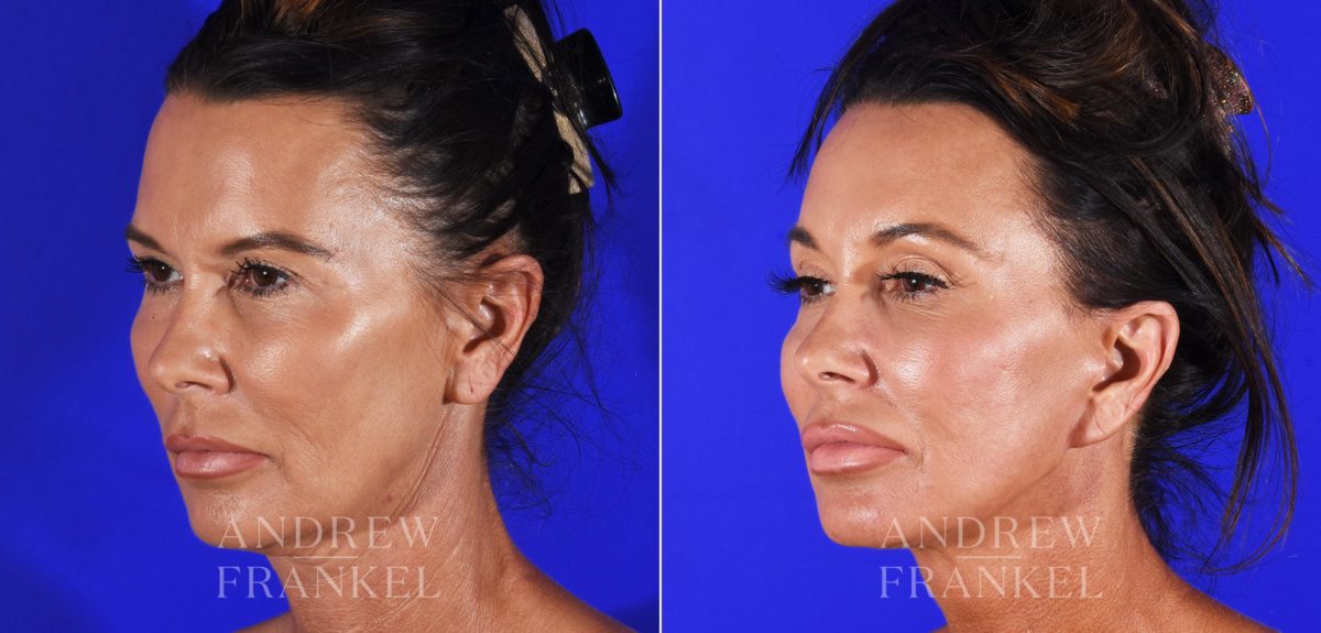 Brow Lift before and after photos in Beverly Hills, CA, Patient 8747