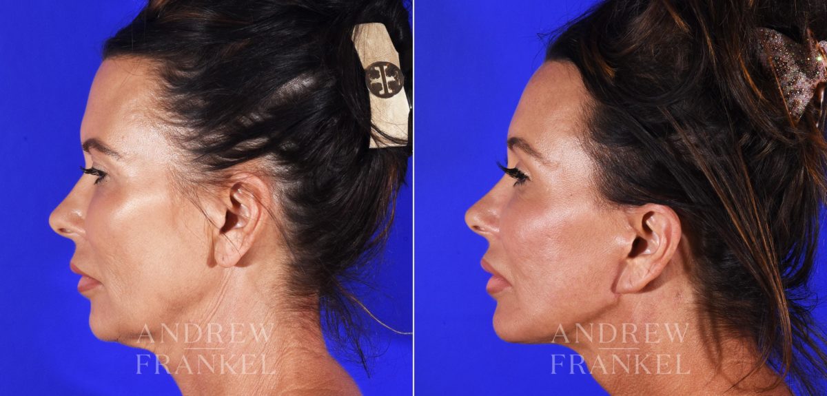 Brow Lift before and after photos in Beverly Hills, CA, Patient 8747