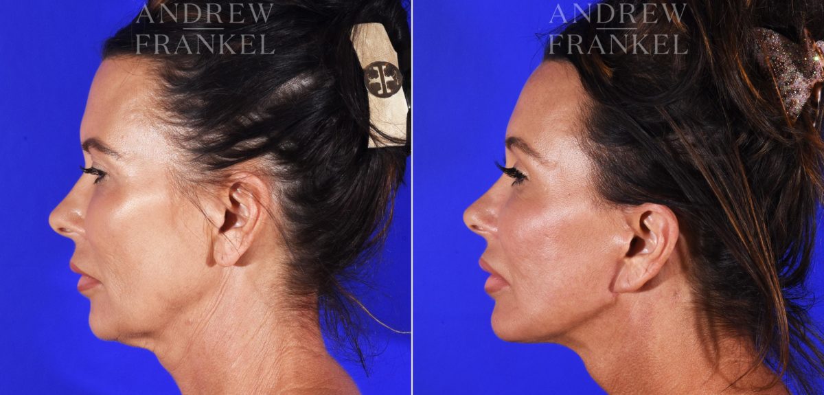 Facelift before and after photos in Beverly Hills, CA, Patient 8772