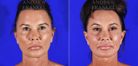 Facelift before and after photos in Beverly Hills, CA, Patient 8772