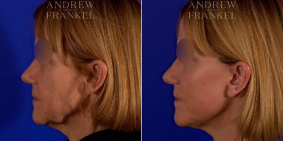 Facial Rejuvenation before and after photos in Beverly Hills, CA, Patient 9021