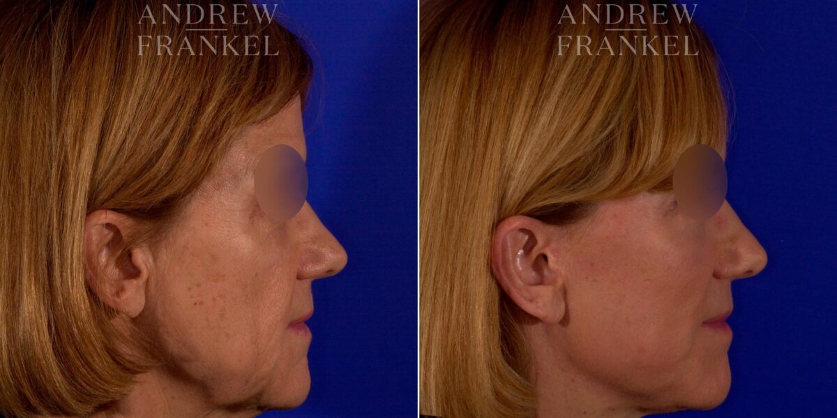 Facial Rejuvenation before and after photos in Beverly Hills, CA, Patient 9021
