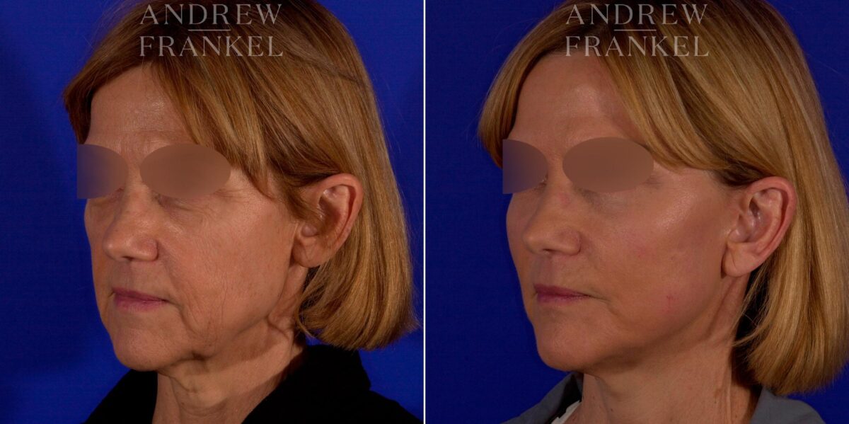 Facial Rejuvenation before and after photos in Beverly Hills, CA, Patient 9021