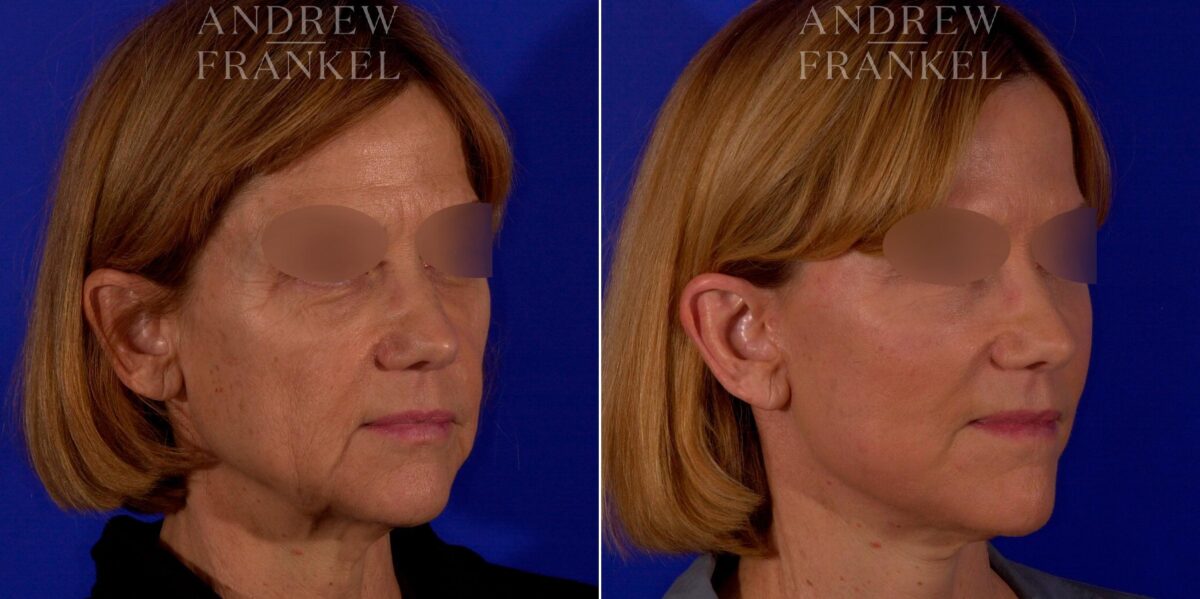 Facial Rejuvenation before and after photos in Beverly Hills, CA, Patient 9021