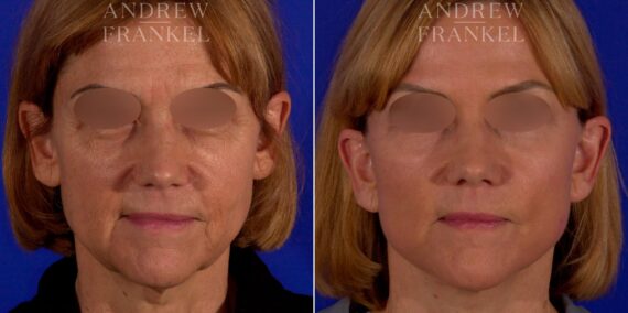 Facial Rejuvenation before and after photos in Beverly Hills, CA, Patient 9021