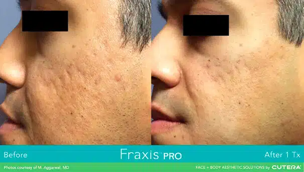 Fraxis PRO Before and After