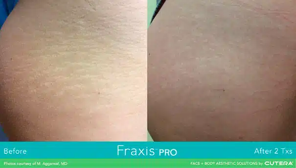 Fraxis PRO Before and After