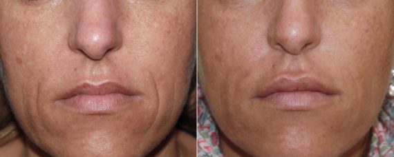 Laser Skin Rejuvenation before and after photos in Beverly Hills, CA, Patient 16243