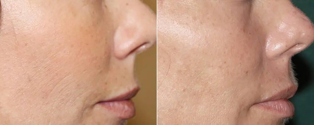 Skin Rejuvenation before and after photos in Beverly Hills, CA, Patient 16249