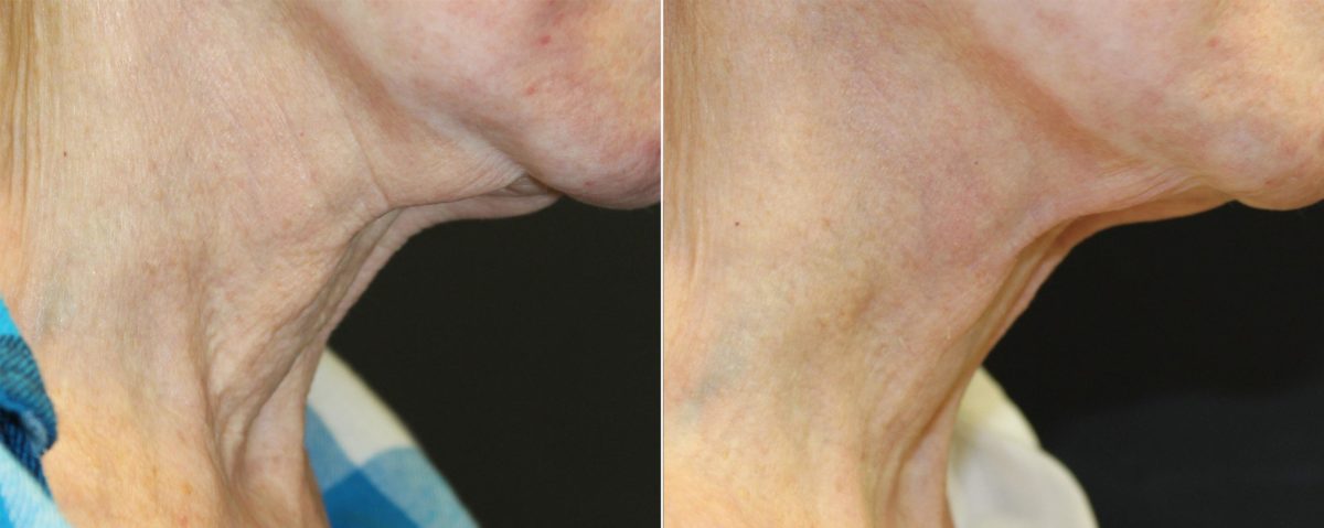 Skin Rejuvenation before and after photos in Beverly Hills, CA, Patient 16254