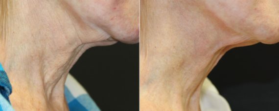 Laser Skin Rejuvenation before and after photos in Beverly Hills, CA, Patient 16254