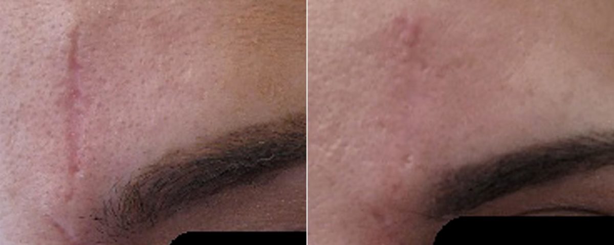Laser Skin Rejuvenation before and after photos in Beverly Hills, CA, Patient 16259