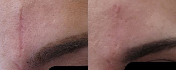 Laser Skin Rejuvenation before and after photos in Beverly Hills, CA, Patient 16259