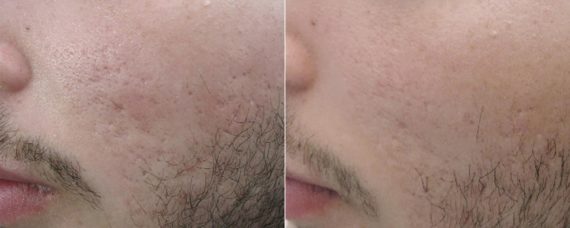 Laser Skin Rejuvenation before and after photos in Beverly Hills, CA, Patient 16264