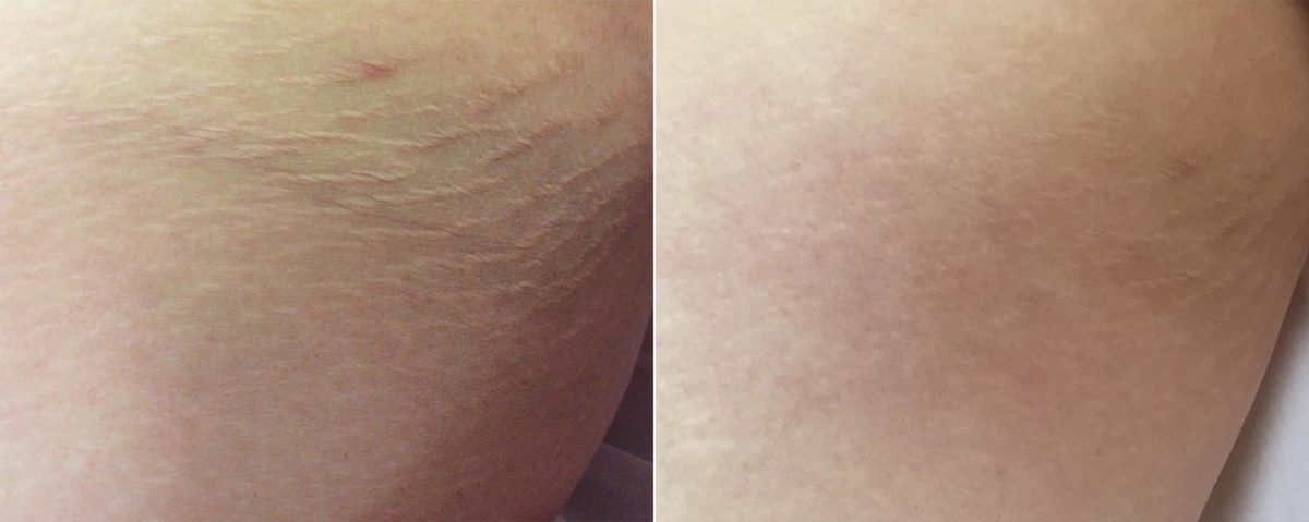 Laser Skin Rejuvenation before and after photos in Beverly Hills, CA, Patient 16269