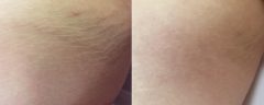 Laser Skin Rejuvenation before and after photos in Beverly Hills, CA, Patient 16269