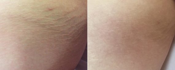 Laser Skin Rejuvenation before and after photos in Beverly Hills, CA, Patient 16269