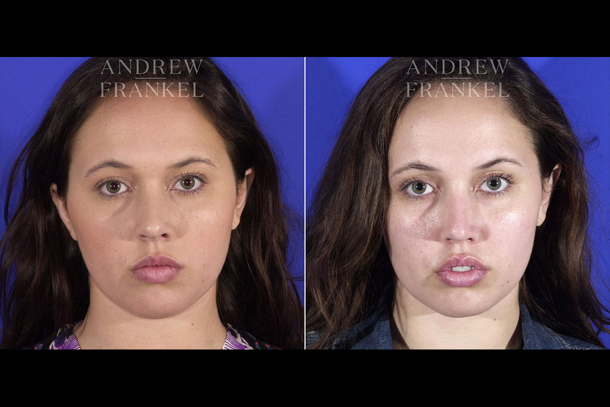 Buccal Fat Removal In Beverly Hills CA Andrew Frankel MD