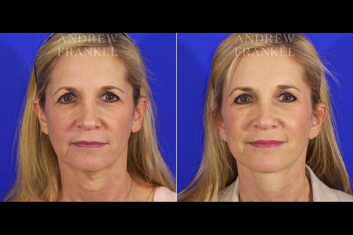 Facelift in Beverly Hills, CA Renowned Surgeon Dr. Andrew Frankel
