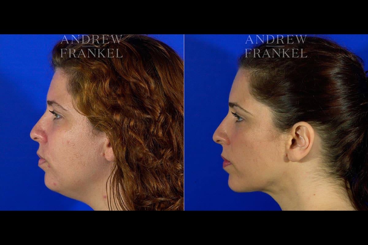 Jawline Contouring  Virginia, Washington D.C. and Maryland