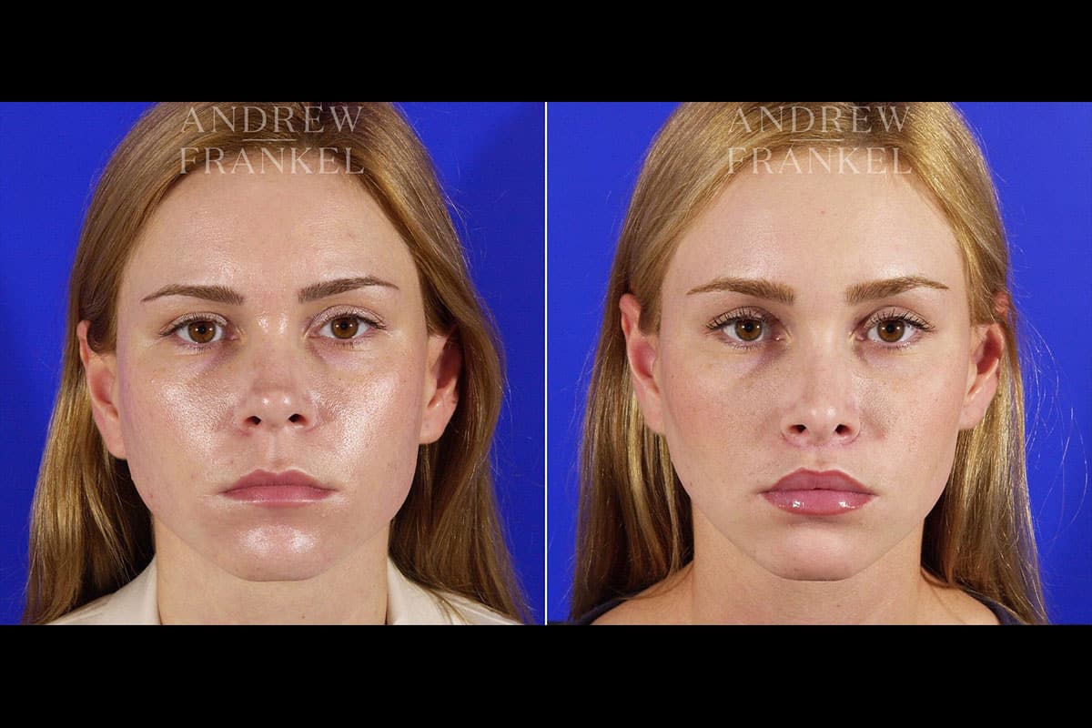 Lip Lift Beverly Hills, CA Dr. Andrew Frankel
