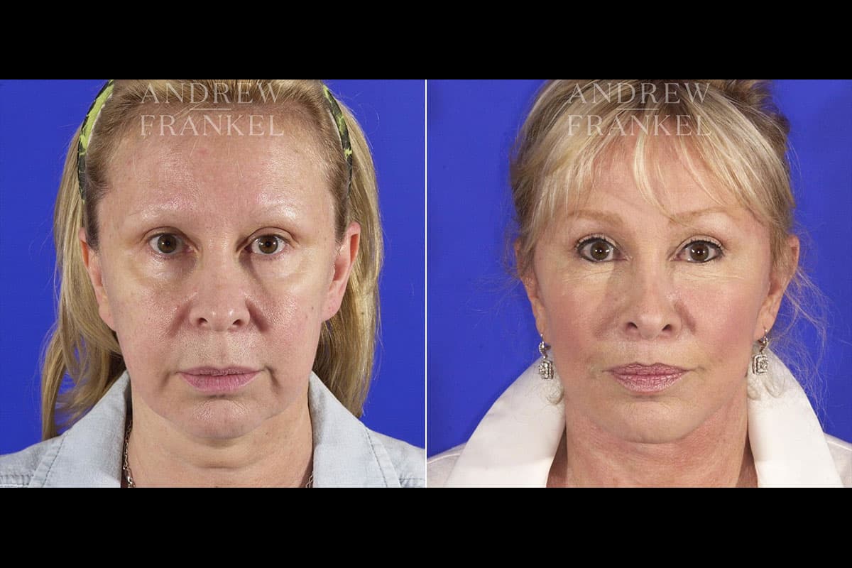 Mid Facelift Beverly Hills, CA Dr. Frankel