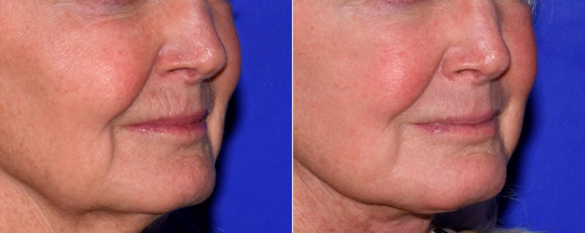 Laser Skin Rejuvenation before and after photos in Beverly Hills, CA, Patient 16687