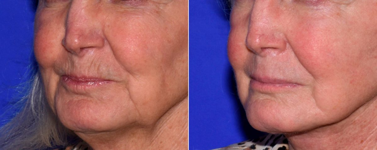 Laser Skin Rejuvenation before and after photos in Beverly Hills, CA, Patient 16687