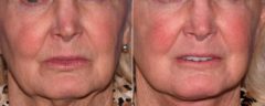 Laser Skin Rejuvenation before and after photos in Beverly Hills, CA, Patient 16687