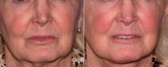 Skin Rejuvenation before and after photos in Beverly Hills, CA, Patient 16687