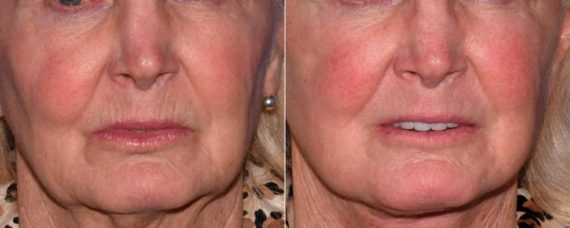 Laser Skin Rejuvenation before and after photos in Beverly Hills, CA, Patient 16687