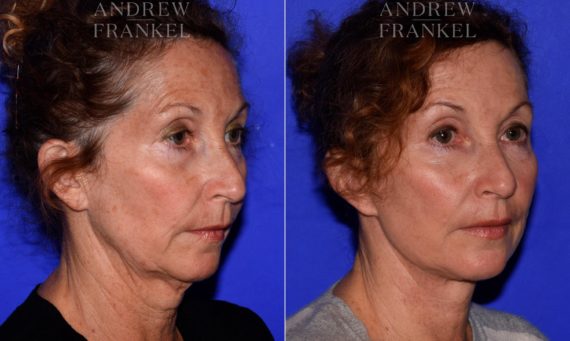 Facelift before and after photos in Beverly Hills, CA, Patient 16768