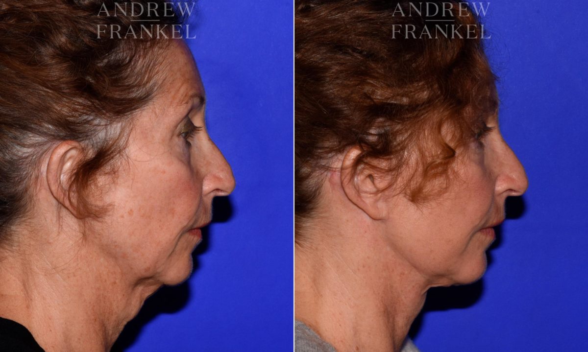 Facelift before and after photos in Beverly Hills, CA, Patient 16768