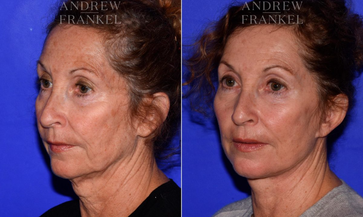 Facelift before and after photos in Beverly Hills, CA, Patient 16768