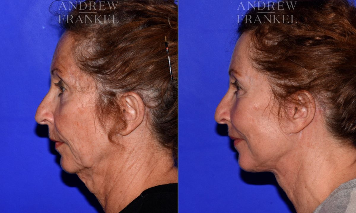 Facelift before and after photos in Beverly Hills, CA, Patient 16768